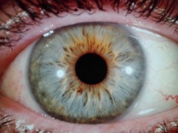 naturheilverfahren-hannover-Augendiagnose-3